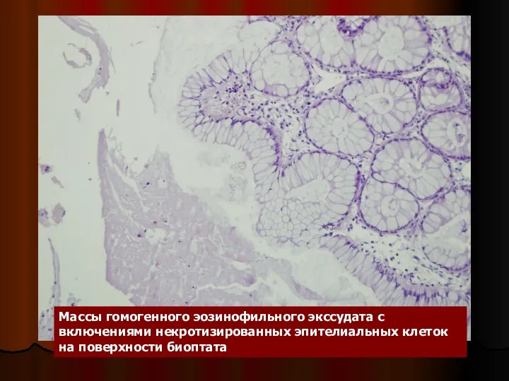 Массы гомогенного эозинофильного экссудата с включениями некротизированных эпителиальных клеток на поверхности биоптата