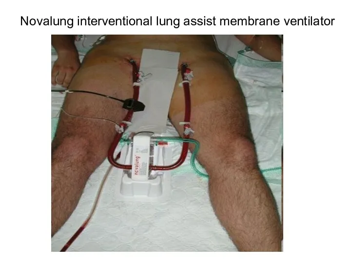 Novalung interventional lung assist membrane ventilator