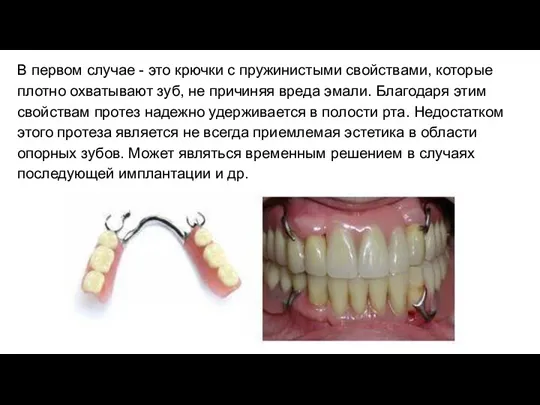 В первом случае - это крючки с пружинистыми свойствами, которые плотно охватывают зуб,