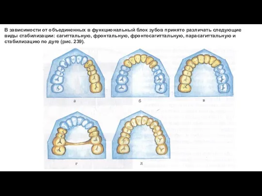 В зависимости от объединенных в функциональный блок зубов принято различать следующие виды стабилизации: