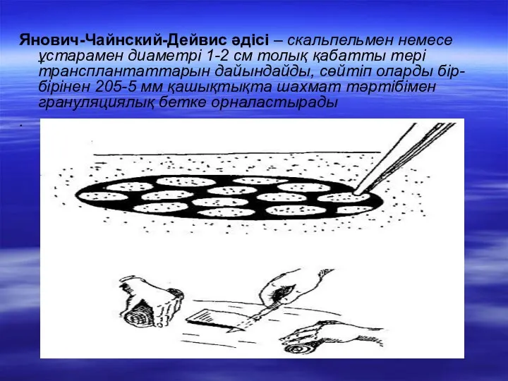 Янович-Чайнский-Дейвис әдісі – скальпельмен немесе ұстарамен диаметрі 1-2 см толық қабатты тері трансплантаттарын