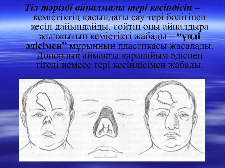 Тіл тәрізді айналмалы тері кесіндісін – кемістіктің қасындағы сау тері бөлігінен кесіп дайындайды,