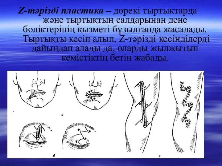 Z-тәрізді пластика – дөрекі тыртықтарда және тыртықтың салдарынан дене бөліктерінің