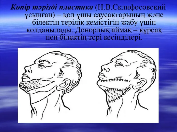 Көпір тәрізді пластика (Н.В.Склифосовский ұсынған) – қол ұшы саусақтарының және білектің терілік кемістігін