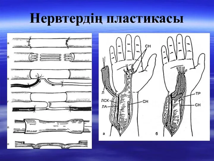 Нервтердің пластикасы