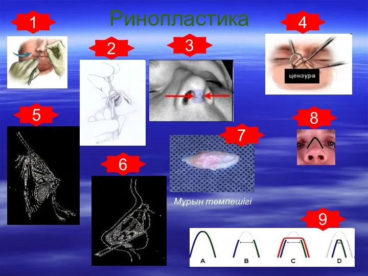 Ринопластика 1 3 4 2 5 6 7 Мұрын төмпешігі 8 9