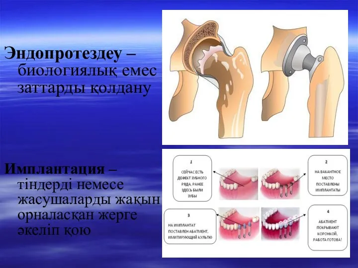 Эндопротездеу – биологиялық емес заттарды қолдану Имплантация – тіндерді немесе жасушаларды жақын орналасқан жерге әкеліп қою