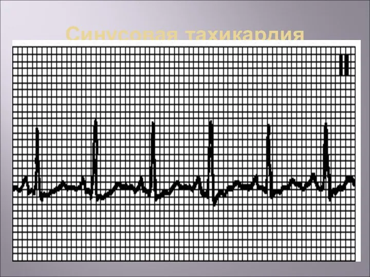 Синусовая тахикардия