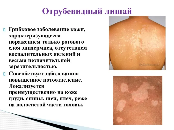 Грибковое заболевание кожи, характеризующееся поражением только рогового слоя эпидермиса, отсутствием