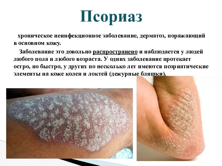 хроническое неинфекционное заболевание, дерматоз, поражающий в основном кожу. Заболевание это