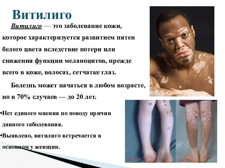 Витилиго — это заболевание кожи, которое характеризуется развитием пятен белого