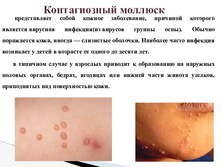 представляет собой кожное заболевание, причиной которого является вирусная инфекция(из вирусов