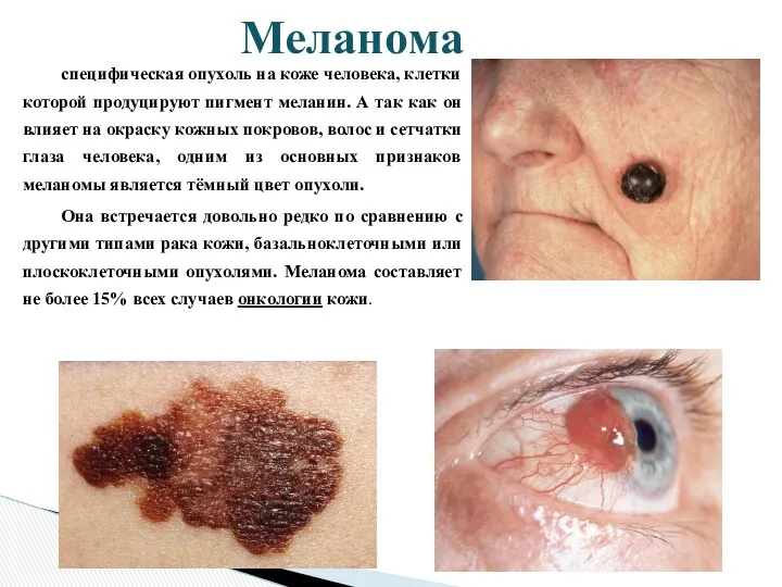 специфическая опухоль на коже человека, клетки которой продуцируют пигмент меланин.