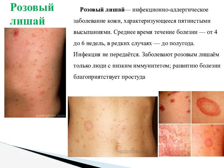 Розовый лишай— инфекционно-аллергическое заболевание кожи, характеризующееся пятнистыми высыпаниями. Среднее время