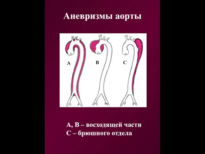 Аневризмы аорты А, В – восходящей части С – брюшного отдела