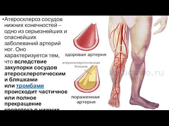 Атеросклероз сосудов нижних конечностей – одно из серьезнейших и опаснейших