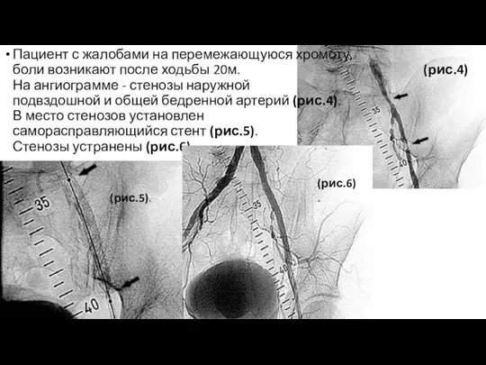 Пациент с жалобами на перемежающуюся хромоту, боли возникают после ходьбы