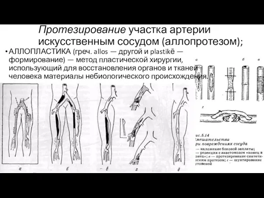 Протезирование участка артерии искусственным сосудом (аллопротезом); АЛЛОПЛАСТИКА (греч. allos —