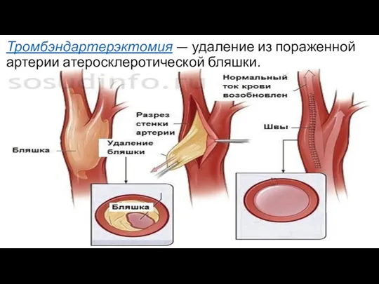 Тромбэндартерэктомия — удаление из пораженной артерии атеросклеротической бляшки.