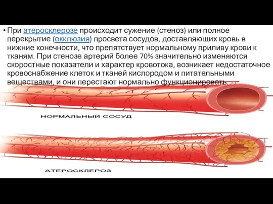 При атеросклерозе происходит сужение (стеноз) или полное перекрытие (окклюзия) просвета