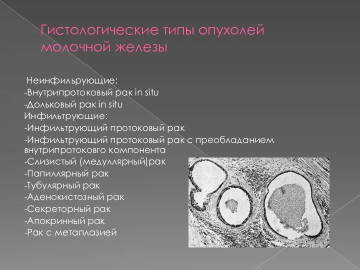 Гистологические типы опухолей молочной железы Неинфильрующие: -Внутрипротоковый рак in situ