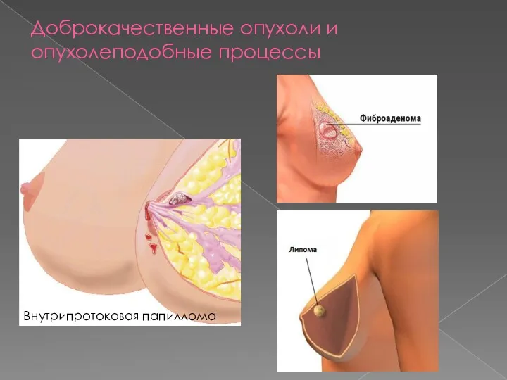 Доброкачественные опухоли и опухолеподобные процессы Внутрипротоковая папиллома