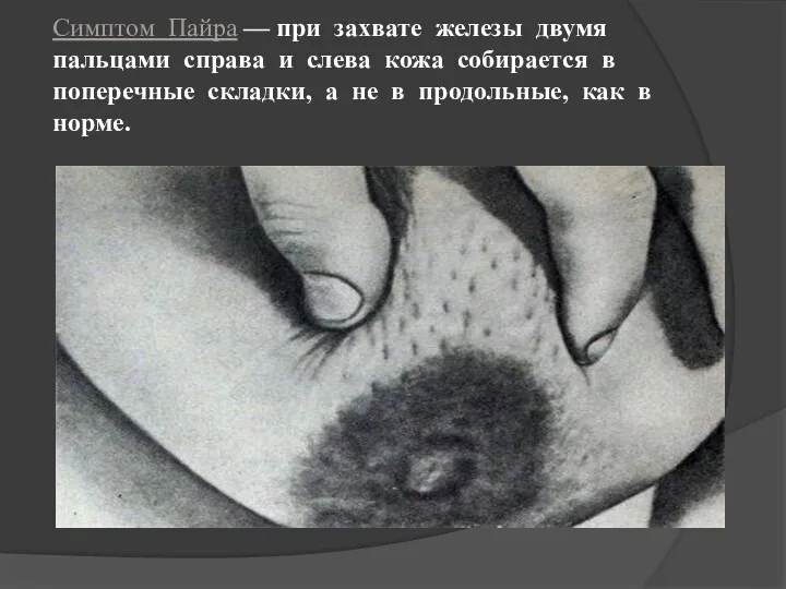 Симптом Пайра — при захвате железы двумя пальцами справа и слева кожа собирается