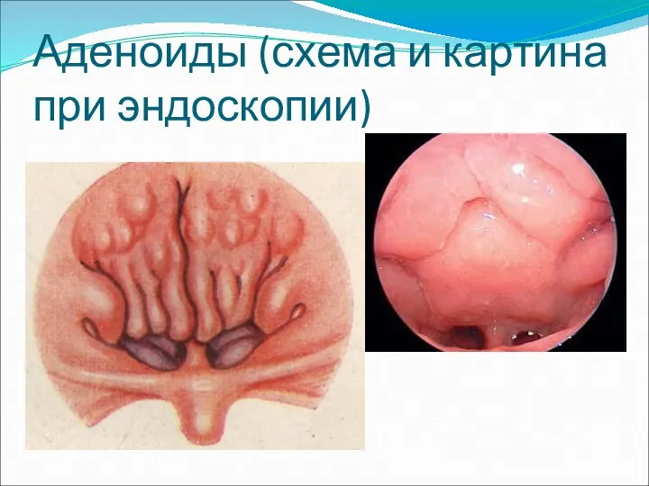 Аденоиды (схема и картина при эндоскопии)