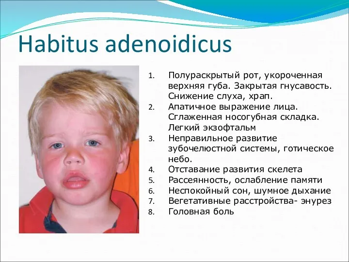 Habitus adenoidicus Полураскрытый рот, укороченная верхняя губа. Закрытая гнусавость. Снижение