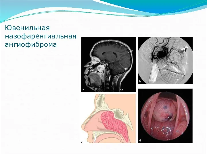 Ювенильная назофаренгиальная ангиофиброма