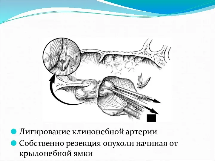 Лигирование клинонебной артерии Собственно резекция опухоли начиная от крылонебной ямки