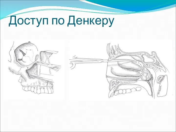 Доступ по Денкеру