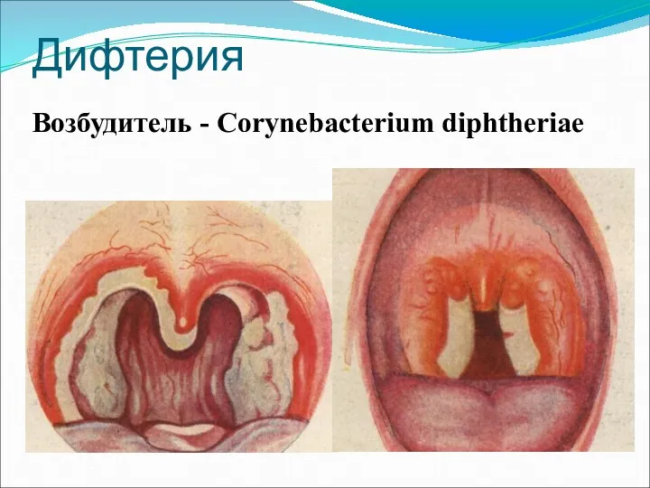 Дифтерия Возбудитель - Corynebacterium diphtheriae