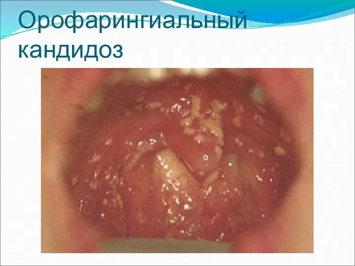 Орофарингиальный кандидоз