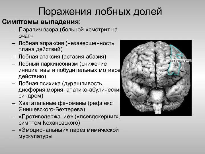 Поражения лобных долей Симптомы выпадения: Паралич взора (больной «смотрит на