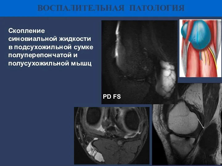 ВОСПАЛИТЕЛЬНАЯ ПАТОЛОГИЯ Скопление синовиальной жидкости в подсухожильной сумке полуперепончатой и полусухожильной мышц