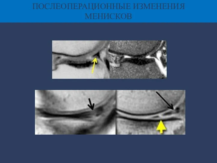 ПОСЛЕОПЕРАЦИОННЫЕ ИЗМЕНЕНИЯ МЕНИСКОВ