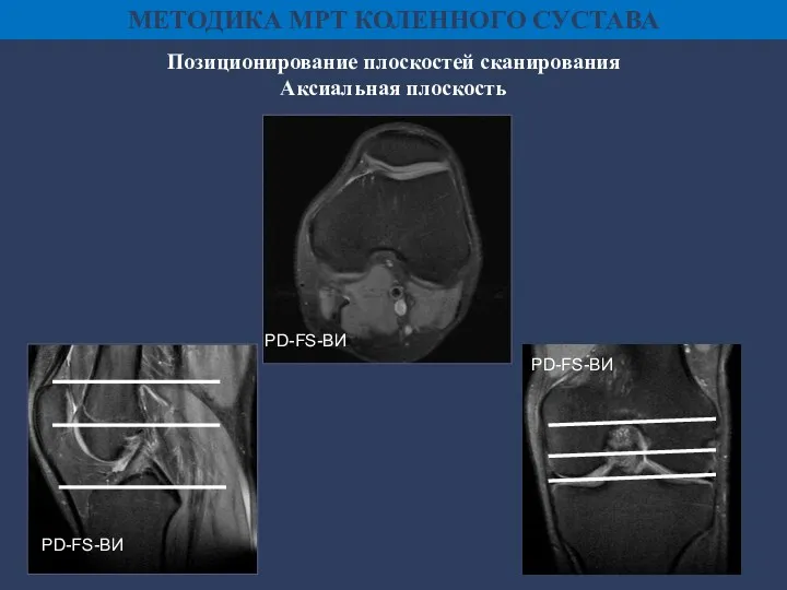 Позиционирование плоскостей сканирования Аксиальная плоскость МЕТОДИКА МРТ КОЛЕННОГО СУСТАВА PD-FS-ВИ PD-FS-ВИ PD-FS-ВИ