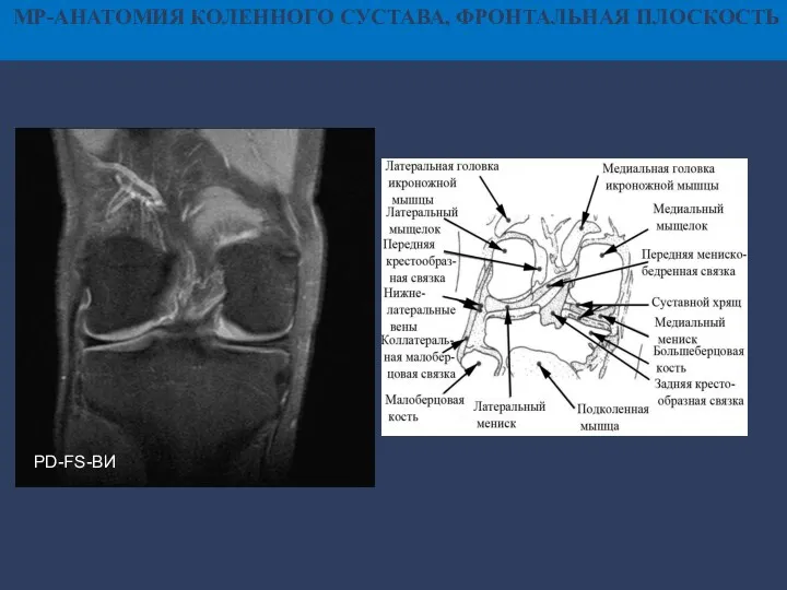 МР-АНАТОМИЯ КОЛЕННОГО СУСТАВА, ФРОНТАЛЬНАЯ ПЛОСКОСТЬ PD-FS-ВИ