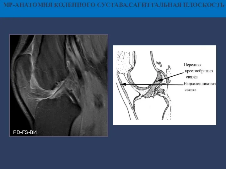 МР-АНАТОМИЯ КОЛЕННОГО СУСТАВА,САГИТТАЛЬНАЯ ПЛОСКОСТЬ PD-FS-ВИ