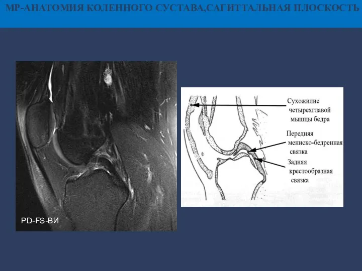 МР-АНАТОМИЯ КОЛЕННОГО СУСТАВА,САГИТТАЛЬНАЯ ПЛОСКОСТЬ PD-FS-ВИ