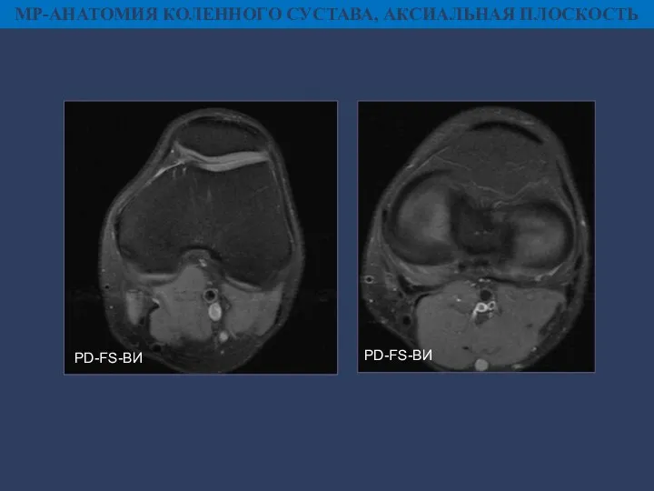 МР-АНАТОМИЯ КОЛЕННОГО СУСТАВА, АКСИАЛЬНАЯ ПЛОСКОСТЬ PD-FS-ВИ PD-FS-ВИ
