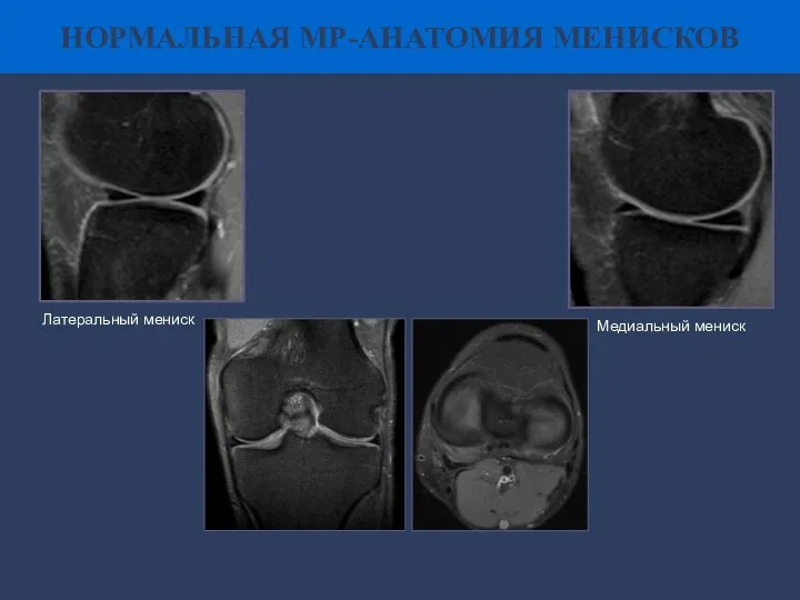 НОРМАЛЬНАЯ МР-АНАТОМИЯ МЕНИСКОВ Латеральный мениск Медиальный мениск