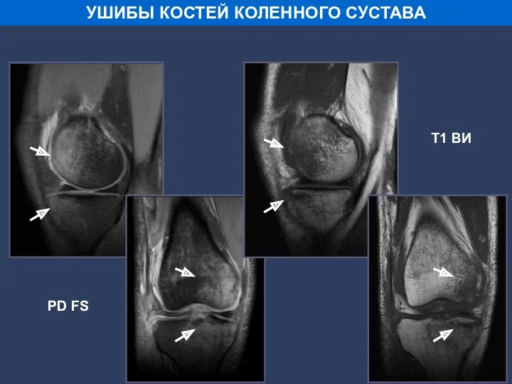 PD FS T1 ВИ УШИБЫ КОСТЕЙ КОЛЕННОГО СУСТАВА