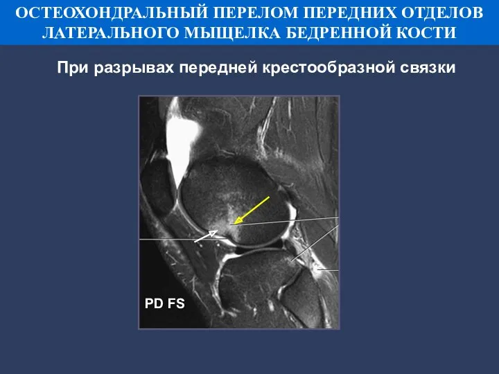 PD FS ОСТЕОХОНДРАЛЬНЫЙ ПЕРЕЛОМ ПЕРЕДНИХ ОТДЕЛОВ ЛАТЕРАЛЬНОГО МЫЩЕЛКА БЕДРЕННОЙ КОСТИ При разрывах передней крестообразной связки