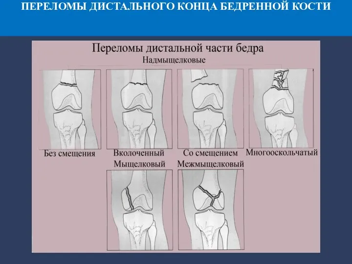 ПЕРЕЛОМЫ ДИСТАЛЬНОГО КОНЦА БЕДРЕННОЙ КОСТИ