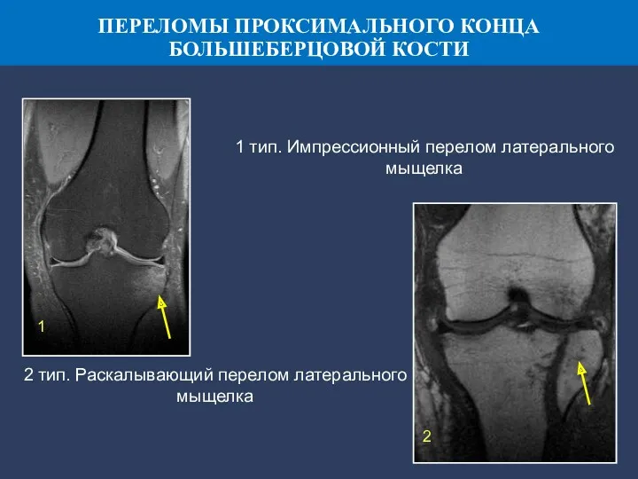 1 тип. Импрессионный перелом латерального мыщелка 2 тип. Раскалывающий перелом