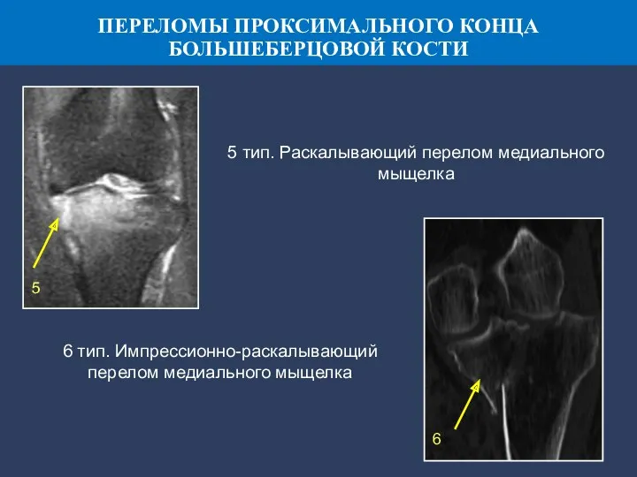 5 тип. Раскалывающий перелом медиального мыщелка 6 тип. Импрессионно-раскалывающий перелом