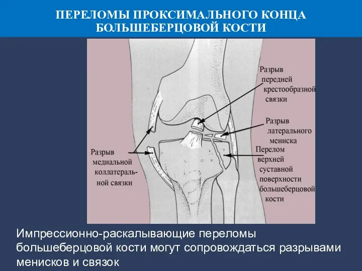 Импрессионно-раскалывающие переломы большеберцовой кости могут сопровождаться разрывами менисков и связок ПЕРЕЛОМЫ ПРОКСИМАЛЬНОГО КОНЦА БОЛЬШЕБЕРЦОВОЙ КОСТИ