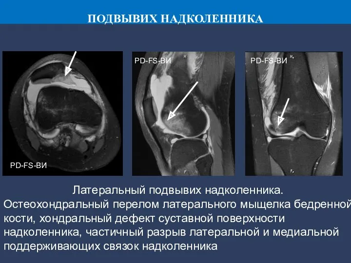 PD-FS-ВИ PD-FS-ВИ PD-FS-ВИ Латеральный подвывих надколенника. Остеохондральный перелом латерального мыщелка